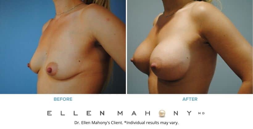 Before and After Image: Case #2826 - left-front-oblique