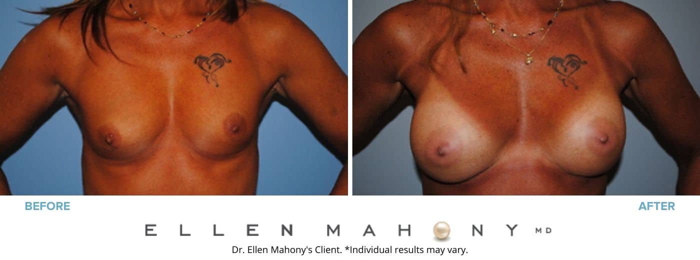 Before and After Image: Case #2833 - front