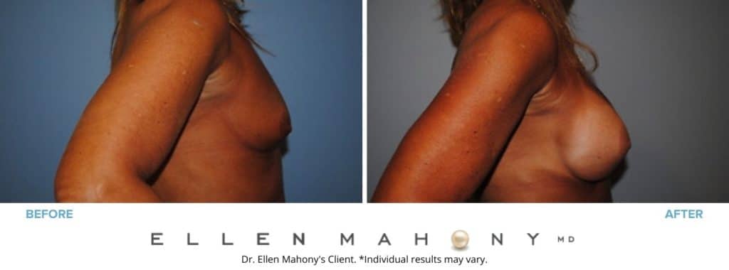 Before and After Image: Case #2833 - right-side