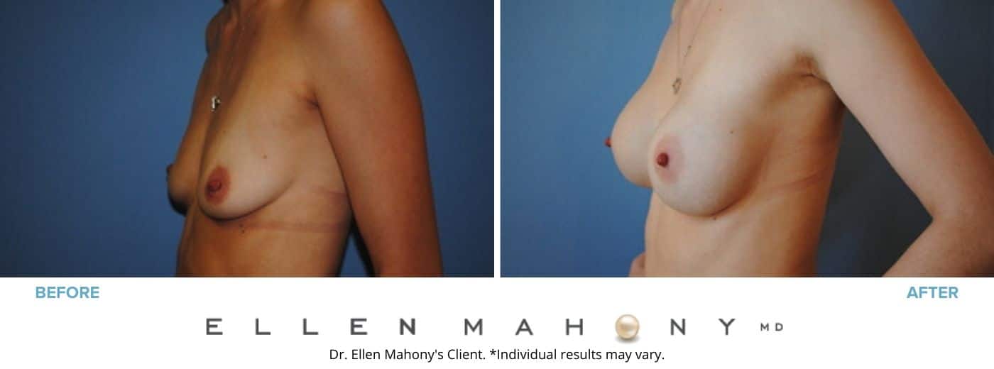 Before and After Image: Case #2840 - left-front-oblique