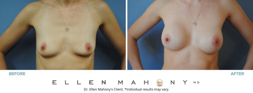 Before and After Image: Case #2840 - front