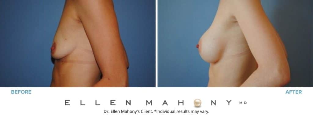 Before and After Image: Case #2840 - left-side