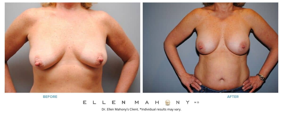 Before and After Image: Case #2861 - front