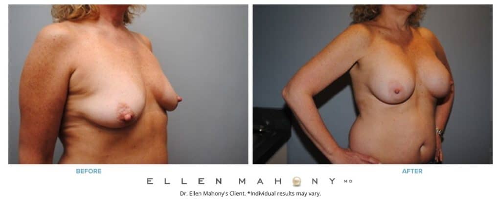 Before and After Image: Case #2861 - right-front-oblique