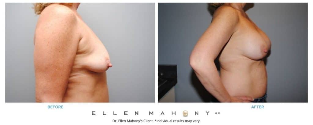 Before and After Image: Case #2861 - right-side