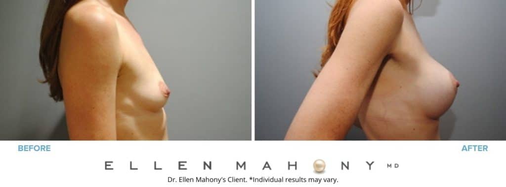 Before and After Image: Case #2868 - right-side
