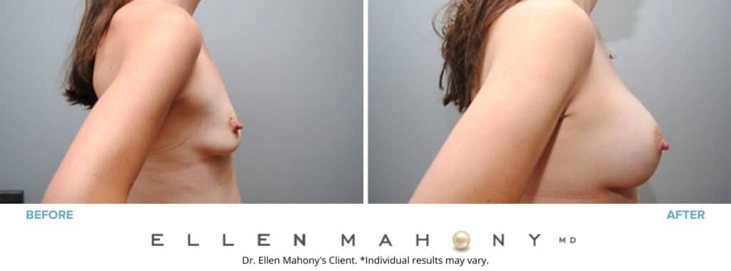 Before and After Image: Case #2875 - right-side