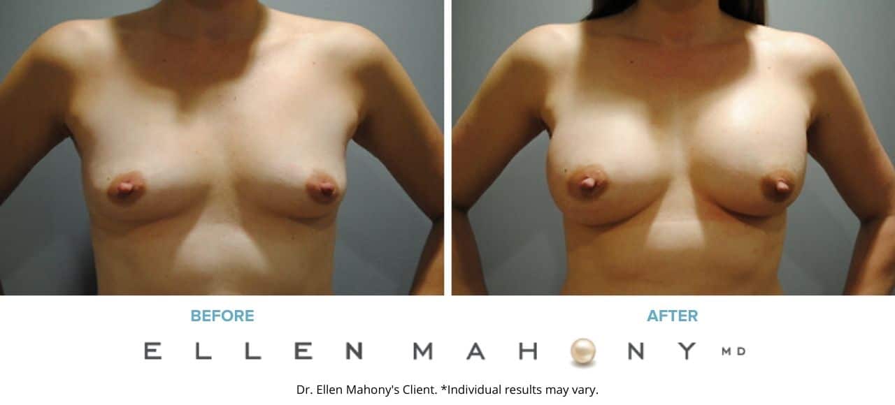 Before and After Image: Case #2905 - front