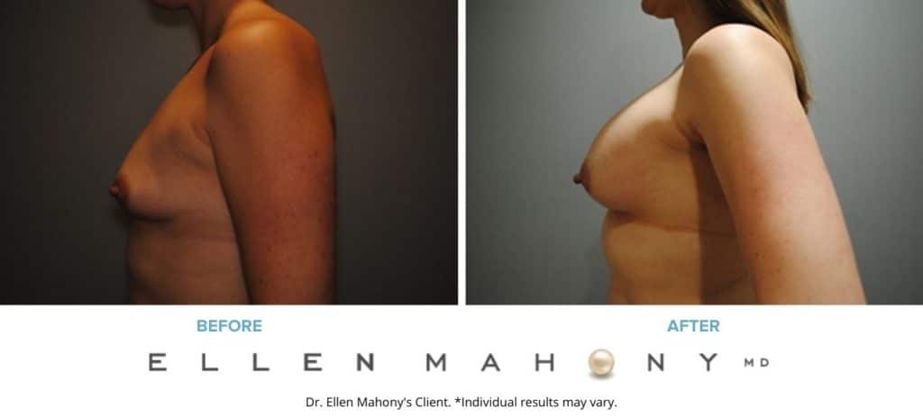 Before and After Image: Case #2905 - left-side