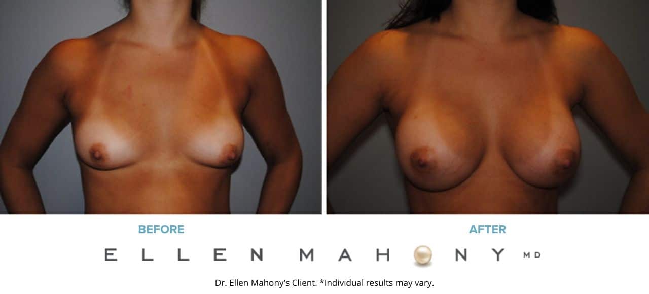 Before and After Image: Case #2914 - front