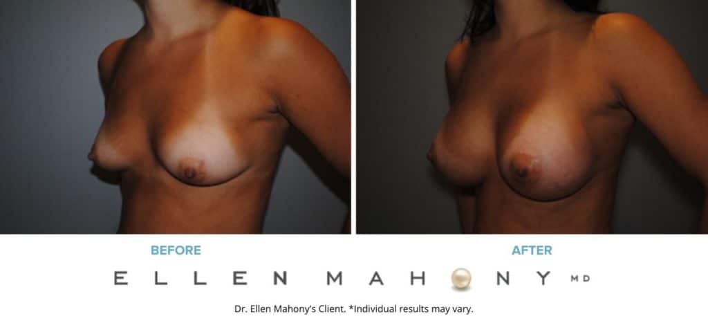 Before and After Image: Case #2914 - left-front-oblique