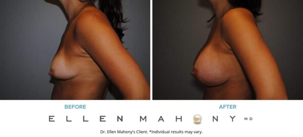 Before and After Image: Case #2914 - left-side