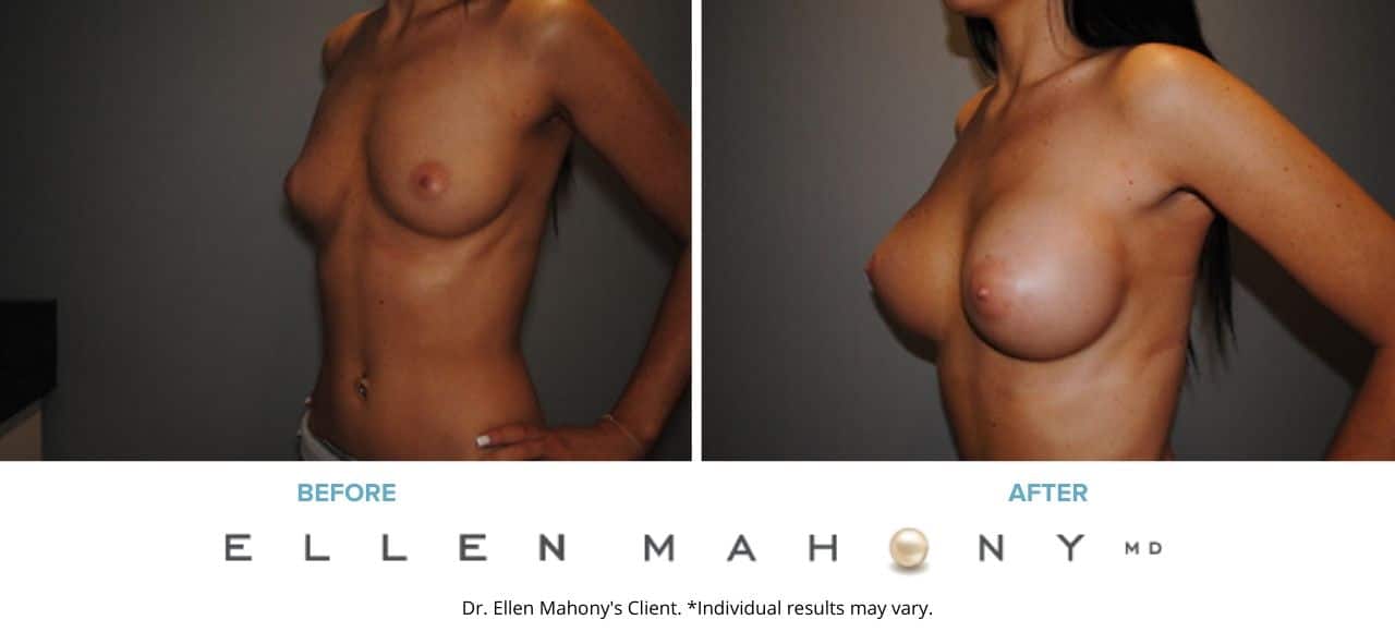 Before and After Image: Case #2925 - left-front-oblique