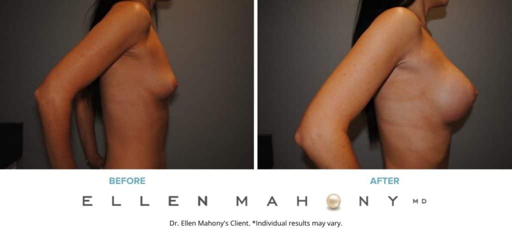 Before and After Image: Case #2925 - right-side
