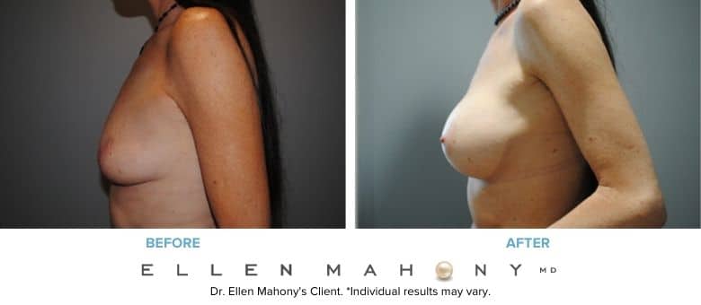 Before and After Image: Case #2936 - left-side