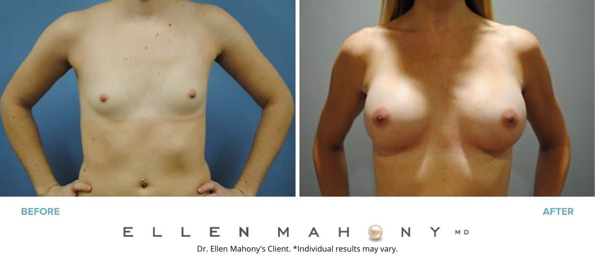 Before and After Image: Case #2954 - front