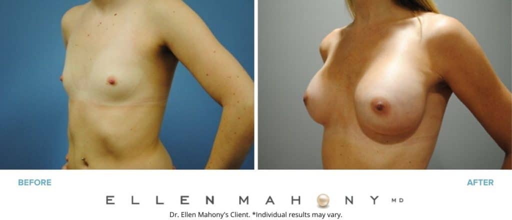 Before and After Image: Case #2954 - left-front-oblique