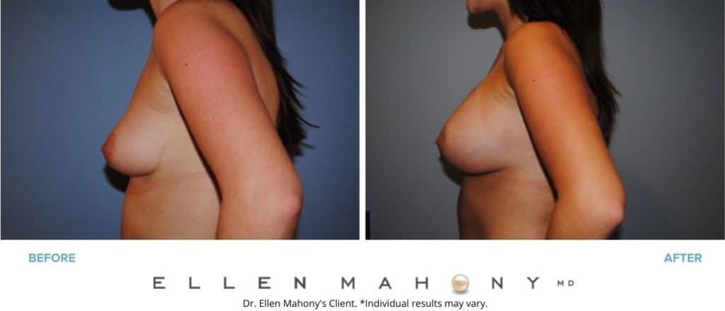 Before and After Image: Case #2969 - left-side
