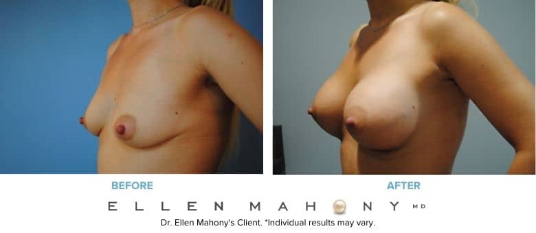 Before and After Image: Case #2974 - left-front-oblique