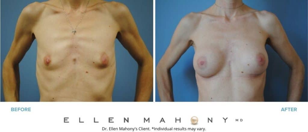Before and After Image: Case #2977 - front