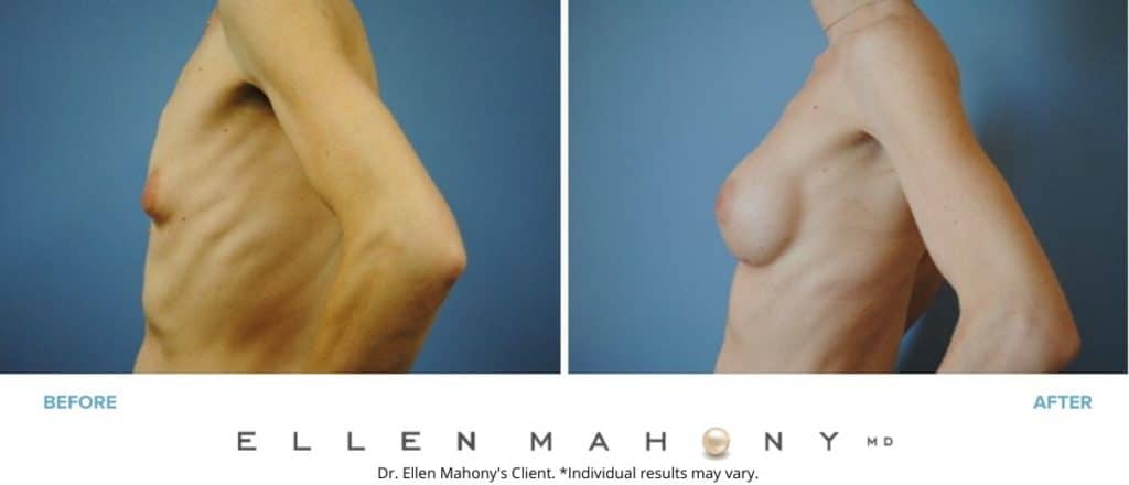 Before and After Image: Case #2977 - left-side