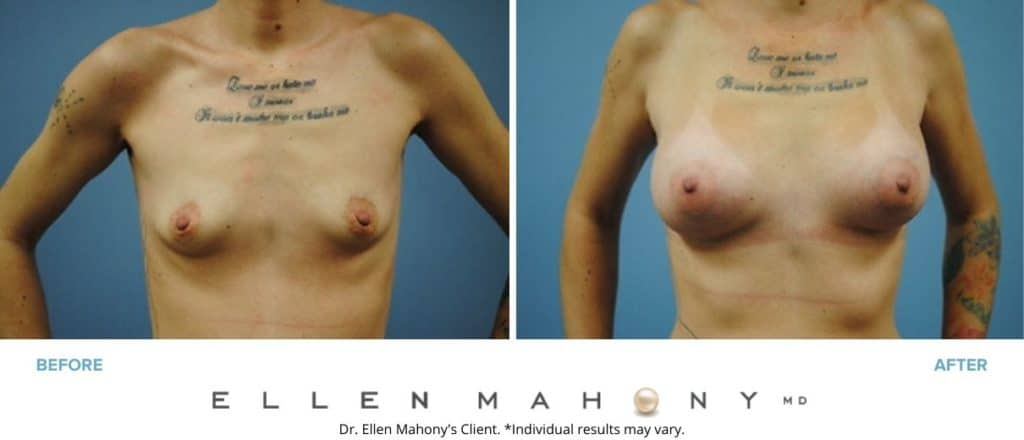 Before and After Image: Case #2988 - front