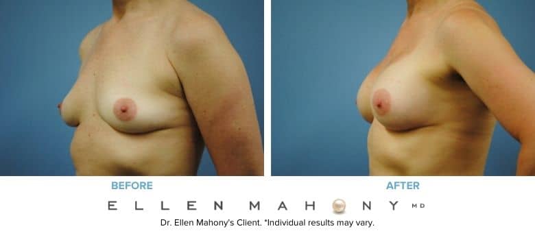 Before and After Image: Case #3017 - left-front-oblique