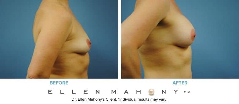 Before and After Image: Case #3017 - right-side