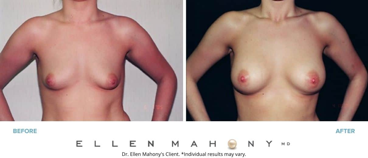 Before and After Image: Case #3028 - front