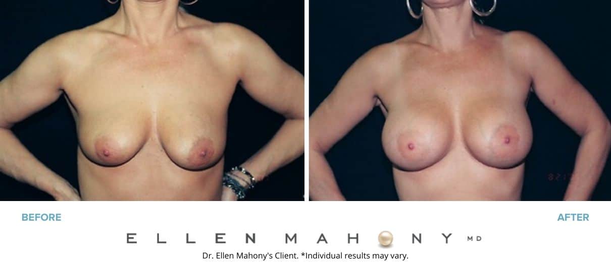 Before and After Image: Case #3033 - front