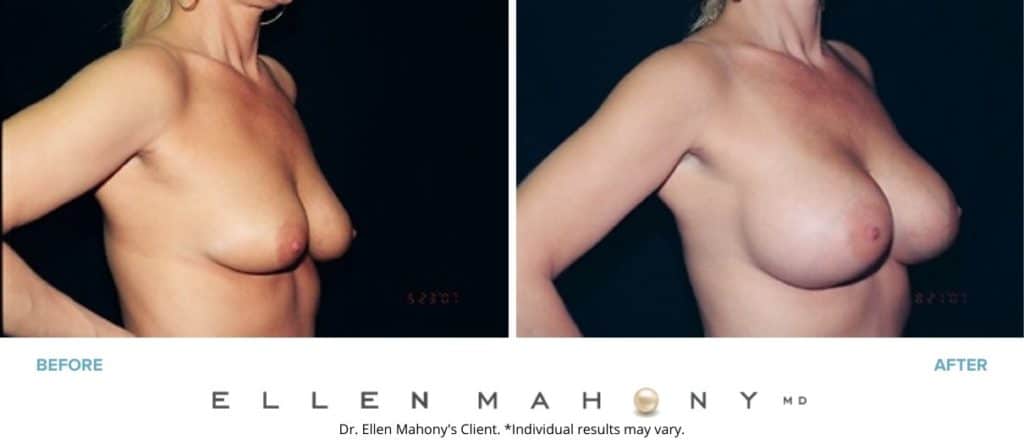 Before and After Image: Case #3033 - right-front-oblique