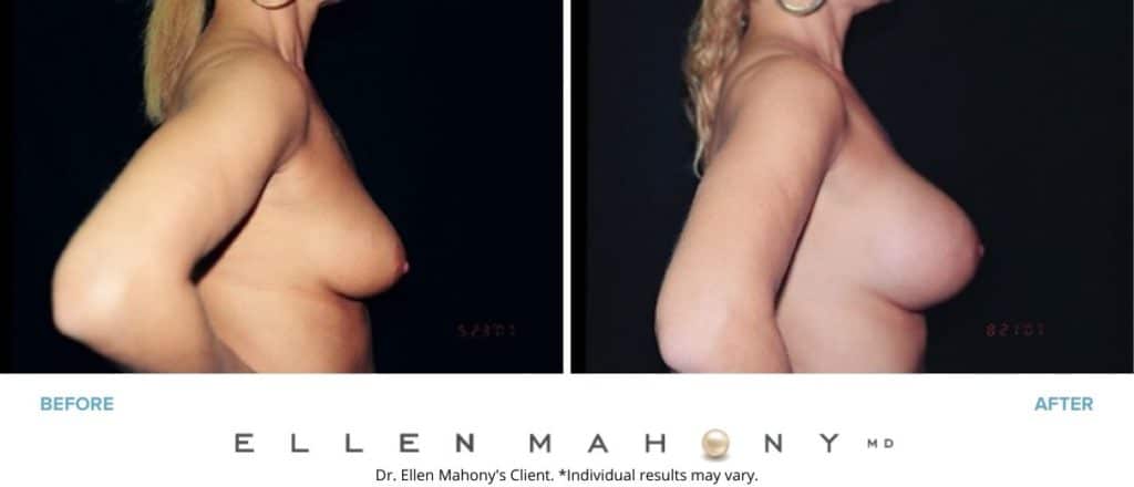 Before and After Image: Case #3033 - right-side
