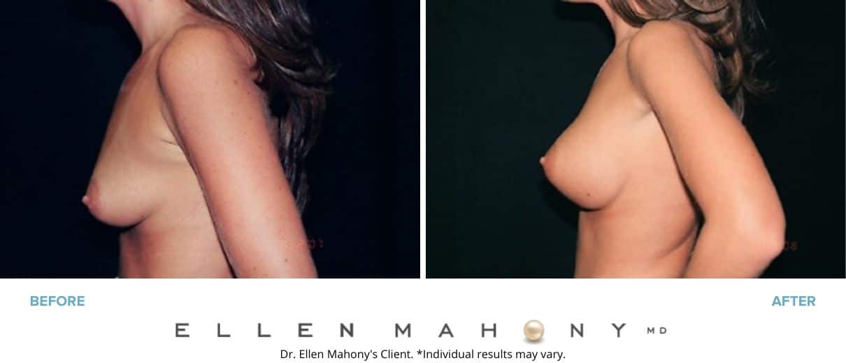 Before and After Image: Case #3040 - left-side