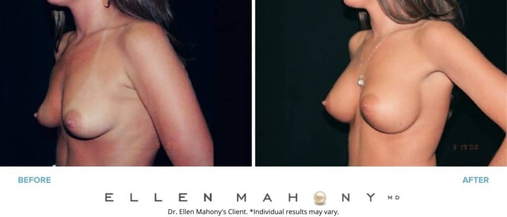 Before and After Image: Case #3040 - left-front-oblique