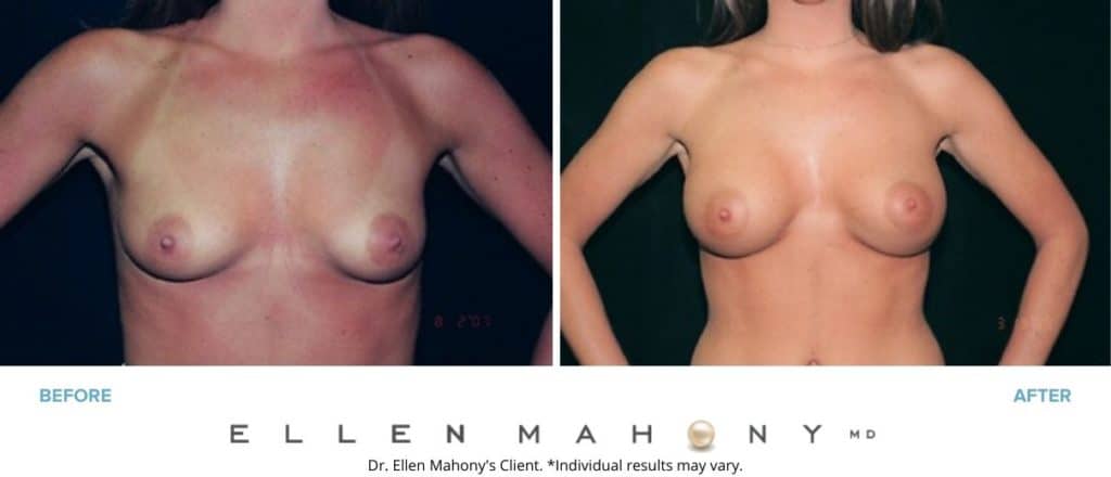 Before and After Image: Case #3040 - front