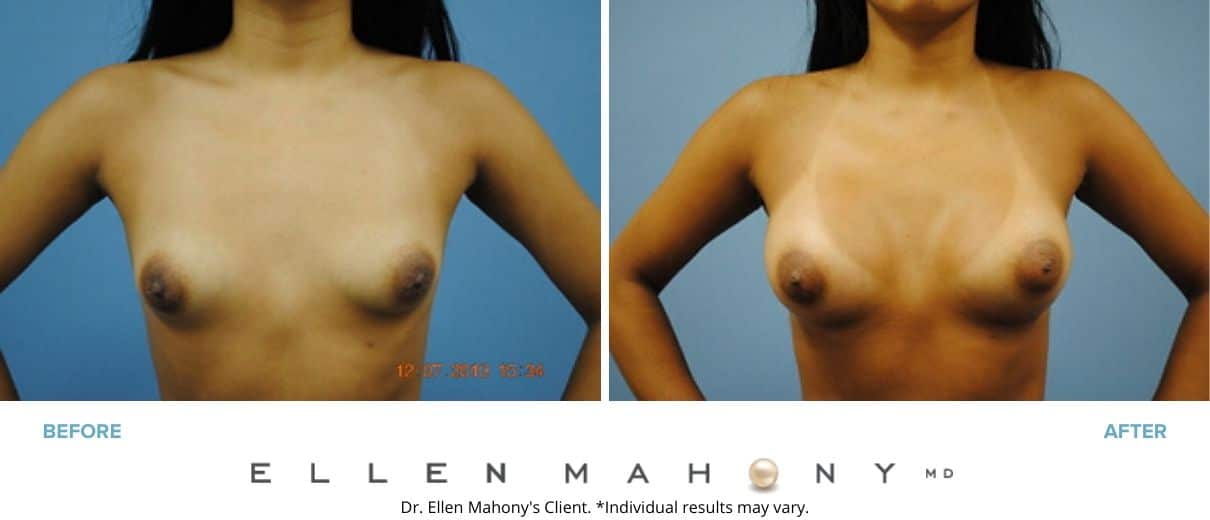 Before and After Image: Case #3047 - front