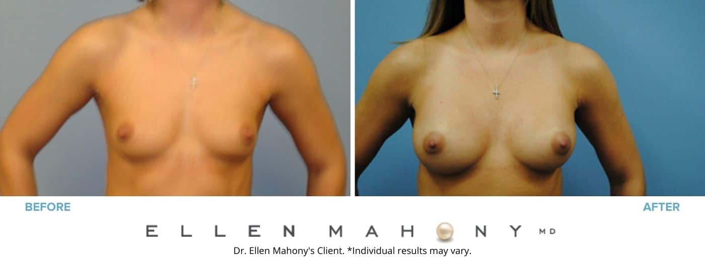 Before and After Image: Case #3062 - front