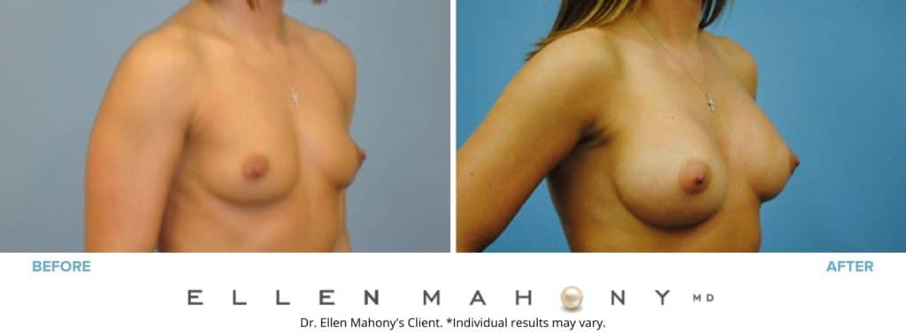 Before and After Image: Case #3062 - right-front-oblique