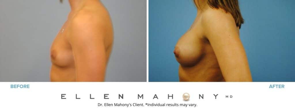 Before and After Image: Case #3062 - left-side
