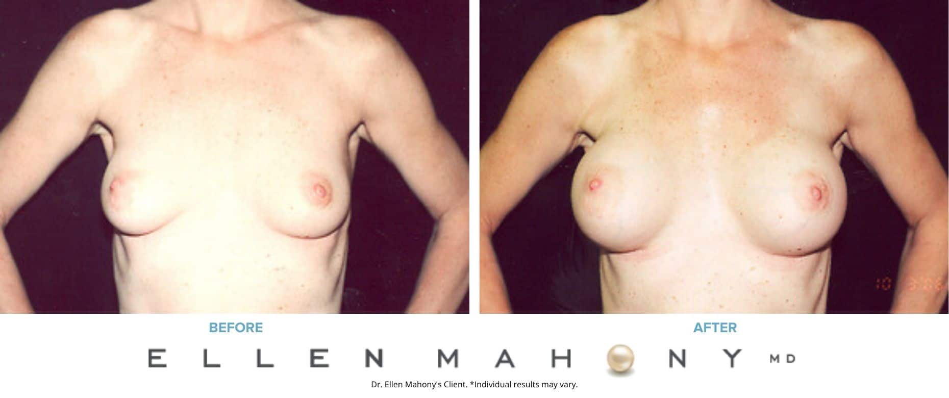 Before and After Image: Case #3069 - front
