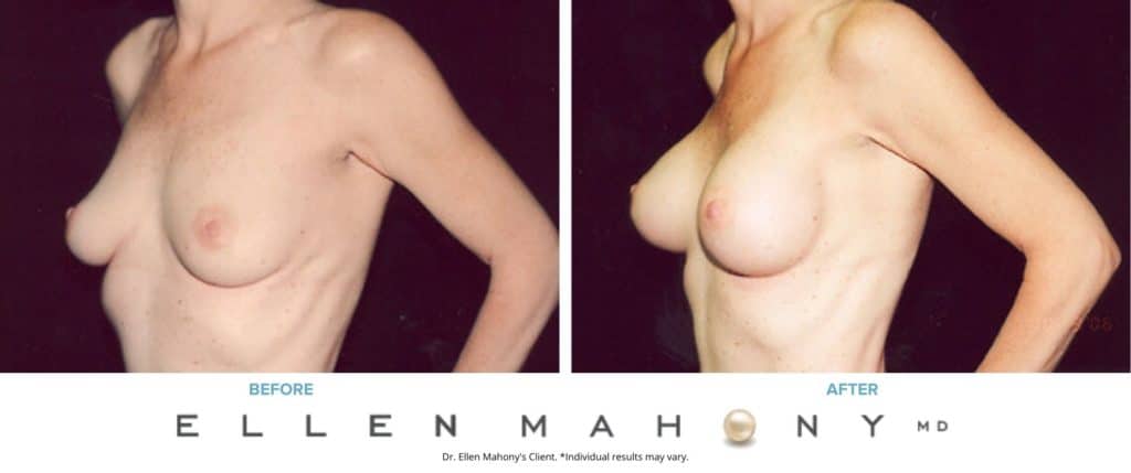 Before and After Image: Case #3069 - left-front-oblique
