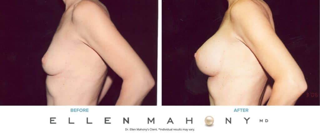 Before and After Image: Case #3069 - left-side
