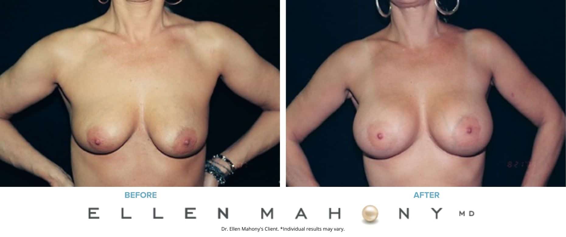 Before and After Image: Case #3076 - front