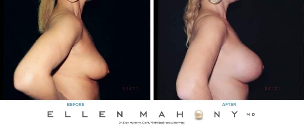 Before and After Image: Case #3076 - right-side