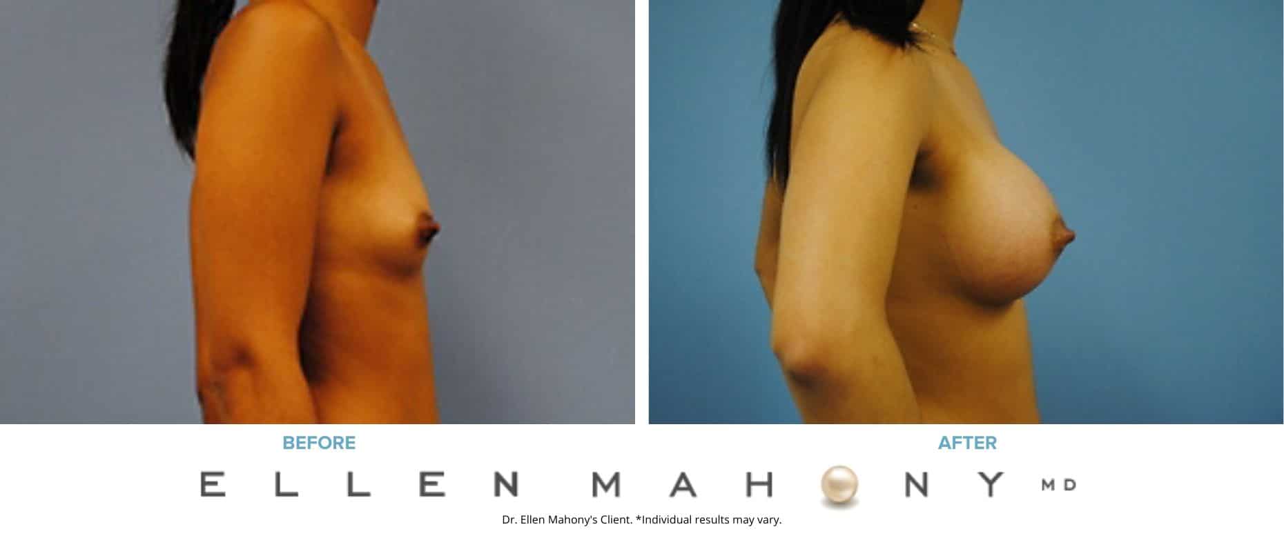 Before and After Image: Case #3083 - right-side