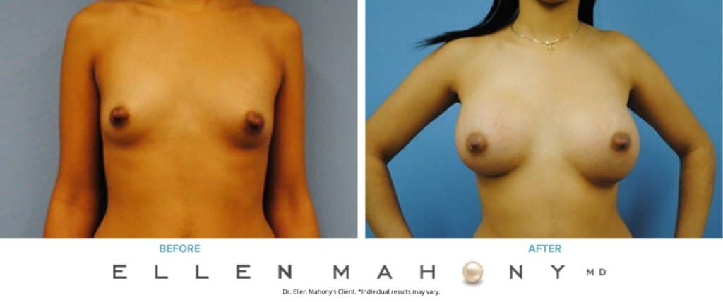 Before and After Image: Case #3083 - front