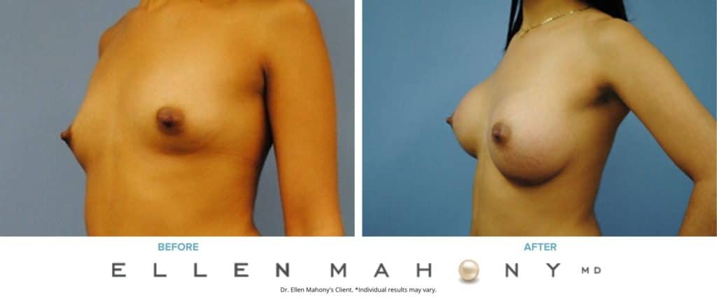 Before and After Image: Case #3083 - left-front-oblique