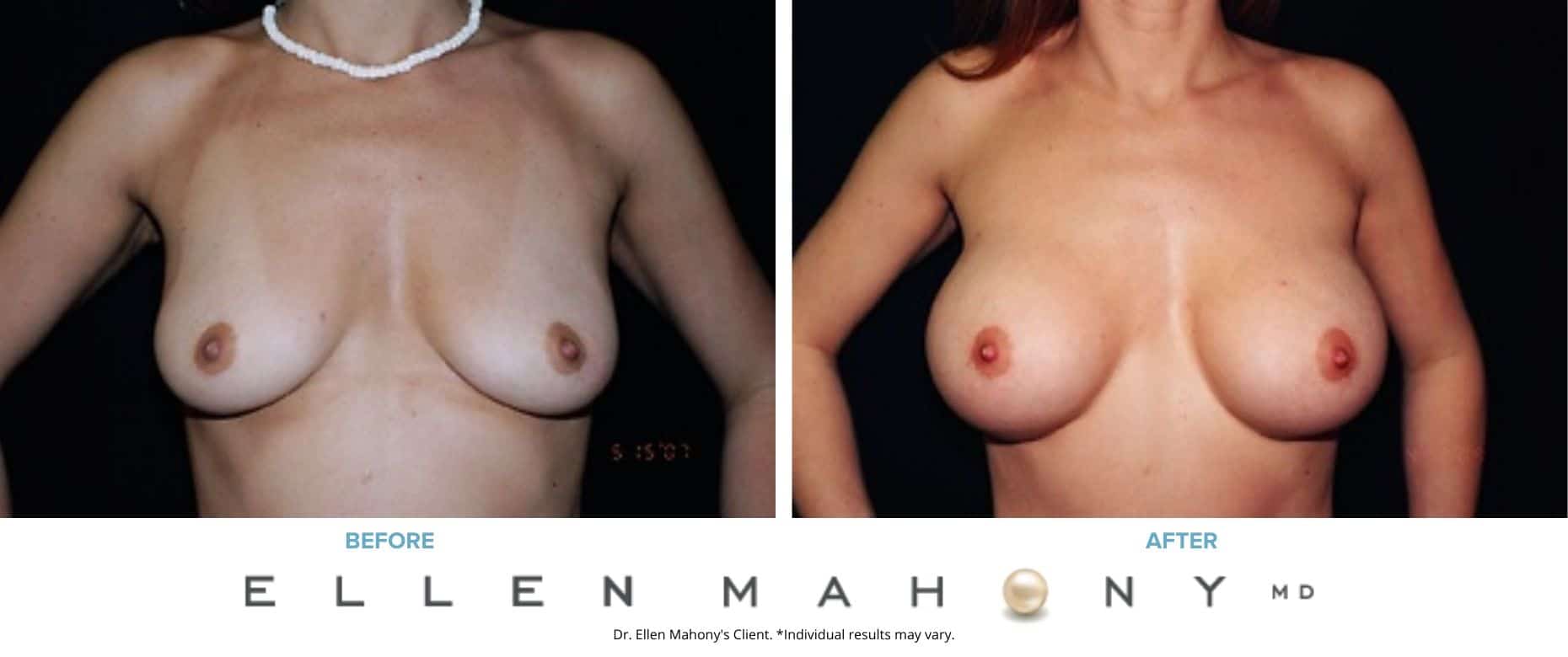 Before and After Image: Case #3090 - front