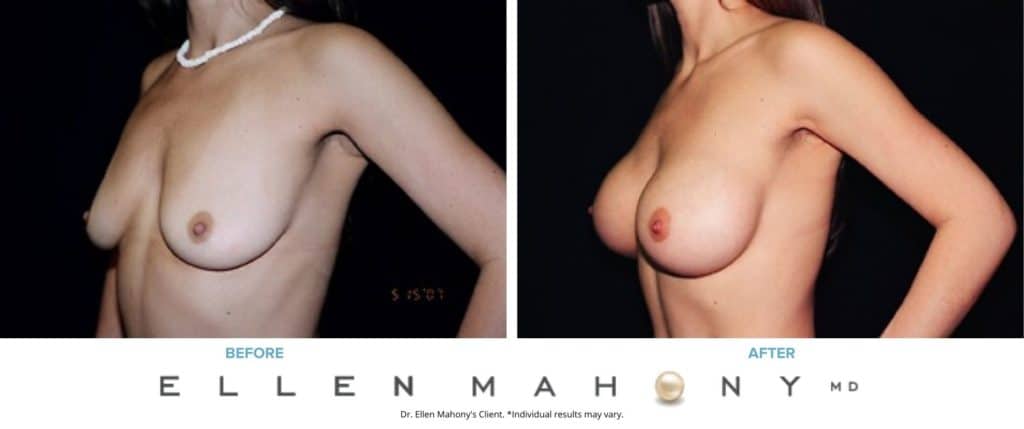 Before and After Image: Case #3090 - left-front-oblique