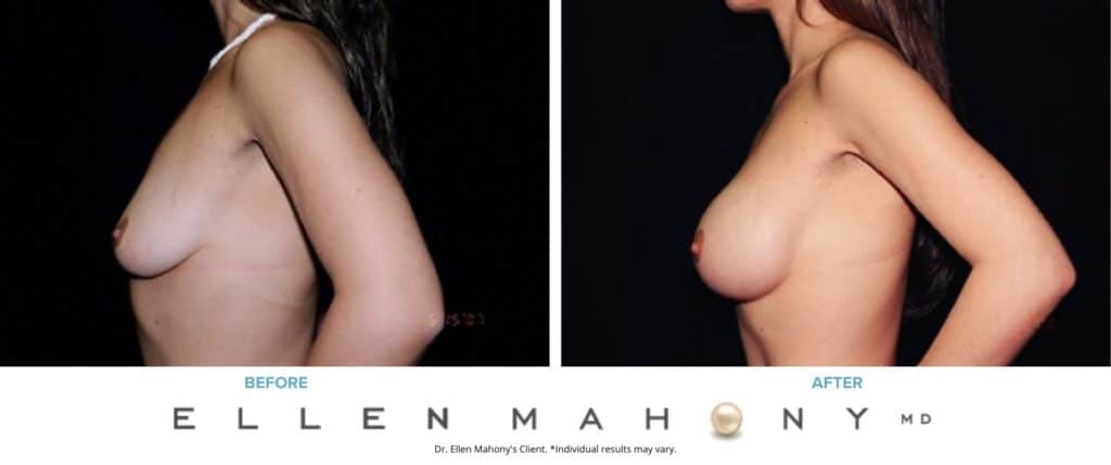 Before and After Image: Case #3090 - left-side